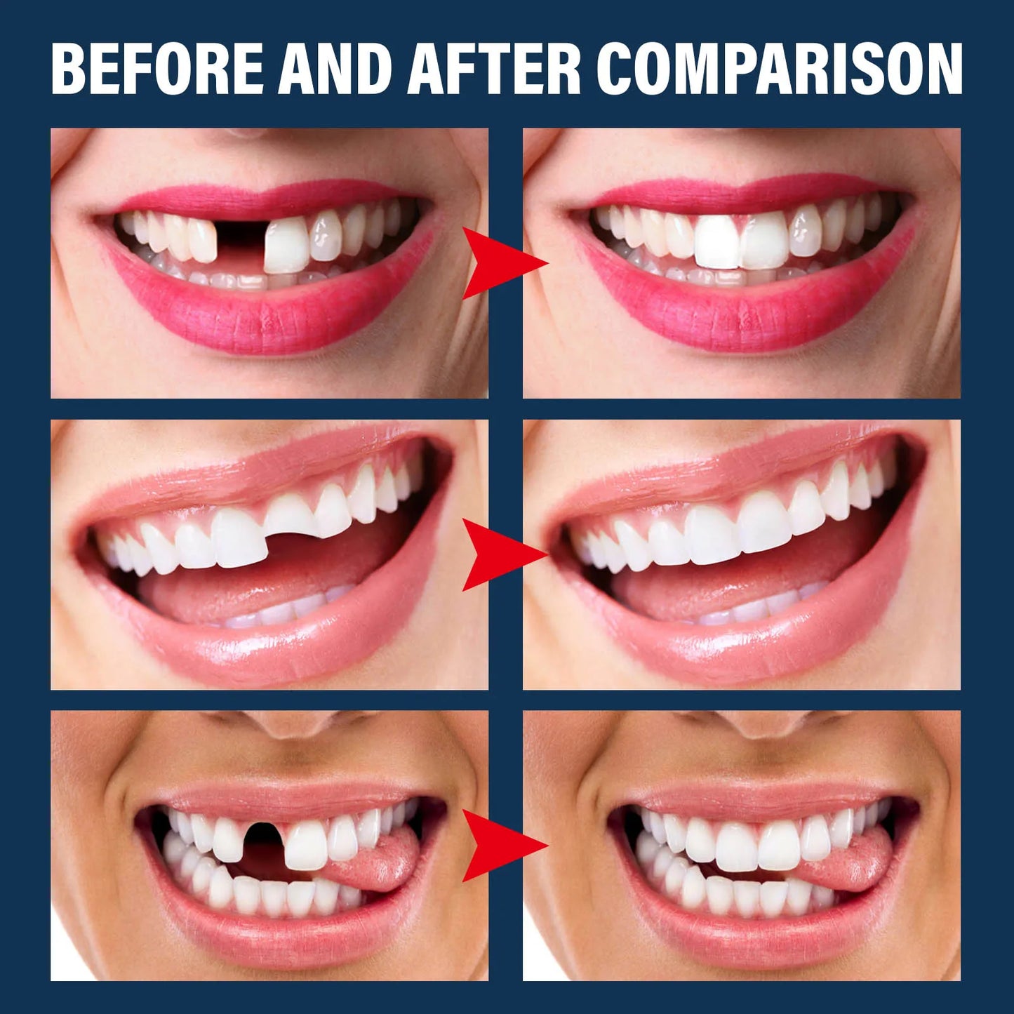 Temporary Tooth Repair Kit – Natural Resin Teeth Replacement Solution